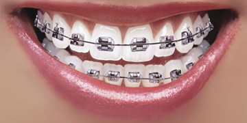 dental-braces