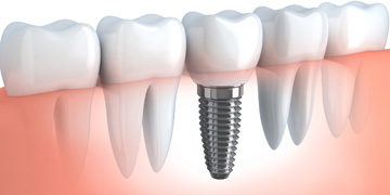 dental-implants-india