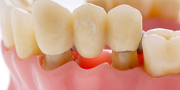 dental-crowns-bridges
