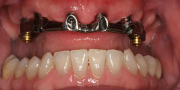 dentures