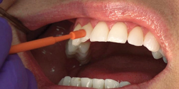 fluoride-treatment
