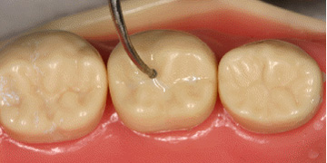 prophylactic-sealants