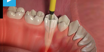 root-canal-treatment