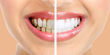 whitening-teeth